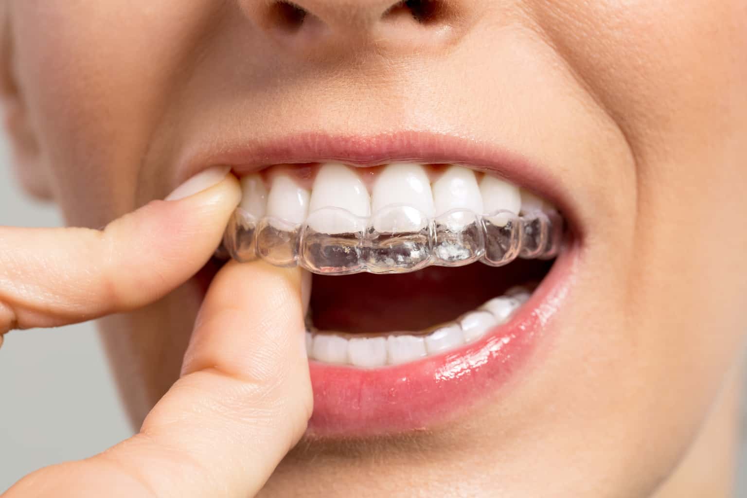 Lingual Braces Wahroonga  Wahroonga Family Dental Centre